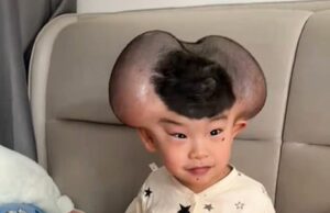 Os pais dos meninos sobre o crescimento gigante causados pelo tratamento para condições raras da pele convertem brutalmente sua alegria ao apelido do ‘Mickey Mouse’ que ele converteu surpreendentemente