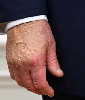 103347581-15231359-A_close_up_shows_US_President_Donald_Trump_s_right_hand_with_hea-a-1_176157588338.avif