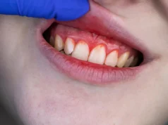 Esses nutrientes simples do tomate podem ajudar a prevenir doenças gengivais graves