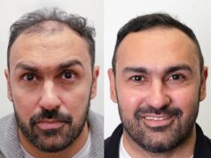 Ex-astro do Aston Villa mostra resultados incríveis de transplante de cabelo que ‘o fizeram se sentir cinco anos mais jovem’