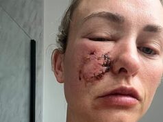 Dona de cachorro que temia que seu animal de estimação ficasse com cicatrizes para o resto da vida depois de atacar seu rosto, pode ‘se olhar no espelho novamente’ após tratamento pioneiro