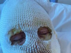 Dois primos sofreram queimaduras horríveis no rosto depois que um aquecedor de pub explodiu, ouviu um tribunal