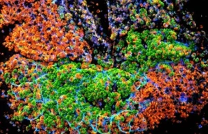 Por que a inflamação intestinal crônica pode levar ao câncer de cólon