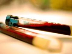 Um simples exame de sangue pode detectar sintomas de Parkinson anos antes de eles se desenvolverem