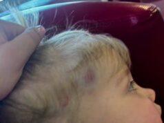 Uma mãe fica furiosa depois que sua filha de três anos foi espancada com uma pá por outra criança na creche