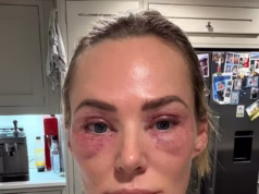 Finalmente, existe uma cura para pálpebras inchadas e bolsas oculares enrugadas. As pessoas agora pensam que sou uma década mais jovem graças a um tratamento revolucionário que dura anos, diz Sarah Lindsay