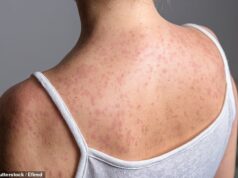 Um surto de sarampo infectou mais de 60 crianças em escolas e creches no norte de Londres