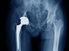 Operações de substituição de quadril e joelho do NHS serão canceladas devido à escassez de cimento ósseo usado para implantes que mudam vidas