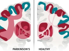 Cientistas descobriram a rede cerebral por trás do Parkinson