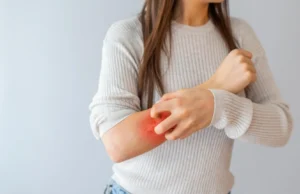 Cientistas descobriram a camada de açúcar escondida por trás da psoríase