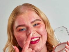 Mulher com marca de nascença no rosto ‘foi questionada por um funcionário da Boots se ela estava usando uma fantasia de vítima queimada na festa de Halloween’