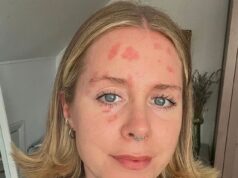 Minha psoríase era tão grave que um estranho cruel perguntou se eu tinha micose. Mas depois de 17 anos tentando inúmeros tratamentos e abandonando o açúcar refinado, o álcool, os laticínios e o trigo – isso é o que realmente funciona para mim.