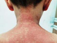 Alerta urgente de saúde sobre o sarampo, pois casos infectados visitam várias lojas nas principais cidades