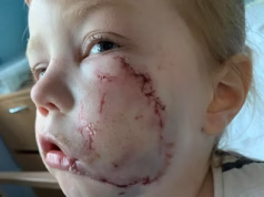 Dono do buldogue americano que atacou uma menina de quatro anos e a deixou com cicatrizes para o resto da vida evita a prisão