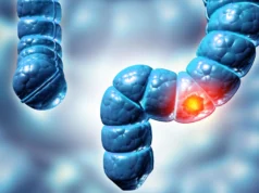 Estudos mostraram que dois tipos de pólipos de cólon podem aumentar o risco de câncer de intestino em cinco vezes