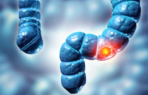 Estudos mostraram que dois tipos de pólipos de cólon podem aumentar o risco de câncer de intestino em cinco vezes