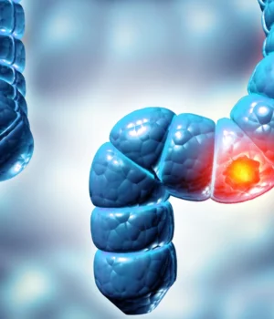 colon-colorectal-cancer.webp.webp