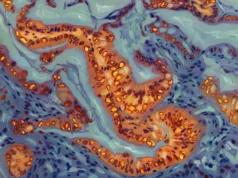 Cientistas descobrem mudança genética que torna o câncer de pâncreas resistente à quimioterapia