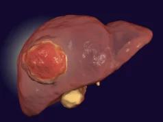 Comer menos proteína pode retardar o crescimento do câncer de fígado, segundo estudo