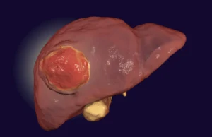 Comer menos proteína pode retardar o crescimento do câncer de fígado, segundo estudo