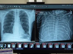 Ele sobreviveu 48 horas sem pulmões e sobreviveu