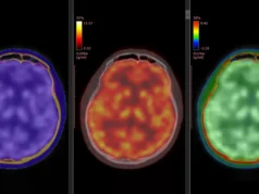 Exames cerebrais revelam como a cetamina elimina rapidamente a depressão aguda