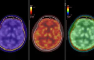 Exames cerebrais revelam como a cetamina elimina rapidamente a depressão aguda
