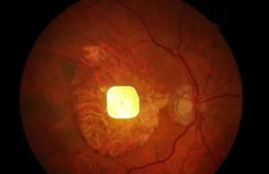 Implantes de retina sem fio ajudam pacientes cegos a enxergar novamente
