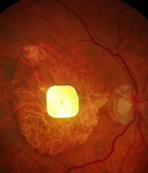 vision-chip-in-patients-eye.webp.webp