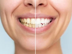 Este novo pó dental branqueia os dentes sem danificá-los