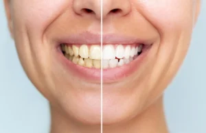 Este novo pó dental branqueia os dentes sem danificá-los