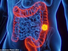 Acompanhamento inovador de estudo sobre câncer de intestino mostra recaída zero