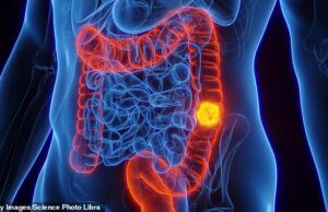 Acompanhamento inovador de estudo sobre câncer de intestino mostra recaída zero