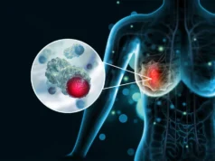 Como o câncer de mama agressivo desliga o sistema imunológico