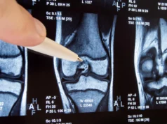 Se uma simples cirurgia no joelho for ineficaz, as coisas podem piorar