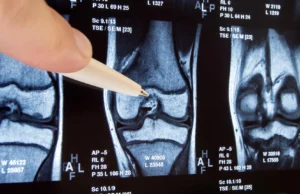 Se uma simples cirurgia no joelho for ineficaz, as coisas podem piorar