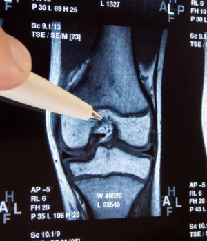 knee-joint-x-ray-or-mri.webp