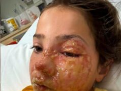 Papai enfrenta reação depois que a filha, de 10 anos, sofreu queimaduras horríveis no rosto quando seu brinquedo viral explodiu