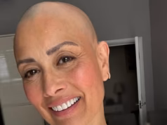 Desde penteados TikTok até não comer carne suficiente, os especialistas revelaram o que pode desencadear a alopecia, já que Melanie Sykes revelou que agora está ‘dois terços’ careca.
