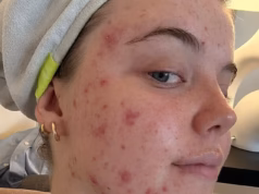 Minha acne debilitante era tão grave que me impediu de sair de casa. Tentei todos os tratamentos durante anos até que um especialista revelou a única coisa que ajudaria – agora minha pele está limpa pela primeira vez em uma década: Chloe Landmore