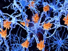 Estas células cerebrais cheias de gordura podem piorar a esclerose múltipla