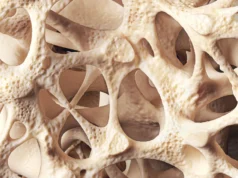 A osteopenia está enfraquecendo silenciosamente os ossos de milhões de pessoas
