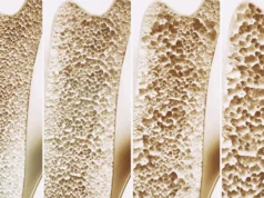 Cientistas descobrem um interruptor na construção óssea que pode combater a osteoporose