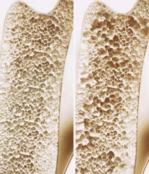 osteoporosis-stages-bone-strength.webp