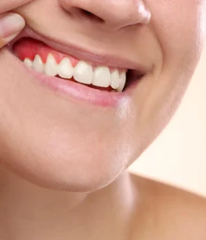 woman-showing-inflamed-gum-disease.webp
