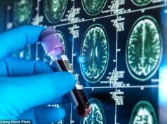 A ‘droga milagrosa’ para Alzheimer pode atrasar a doença em três anos – novo ensaio revela que 90% dos danos cerebrais desaparecem