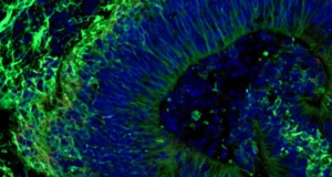 Minicérebros desenvolvidos em laboratório podem prever quais tratamentos para Alzheimer funcionarão