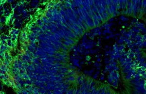Cérebros minúsculos desenvolvidos em laboratório podem prever quais tratamentos para Alzheimer funcionarão