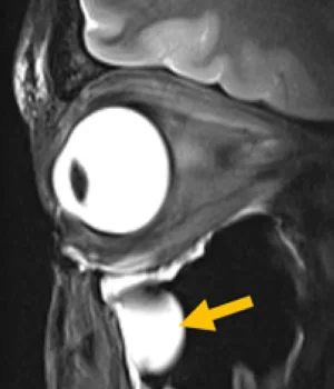 high-resolution-eye-mri.webp
