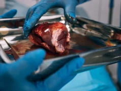 Cerca de metade dos pacientes transplantados renais nunca iniciam